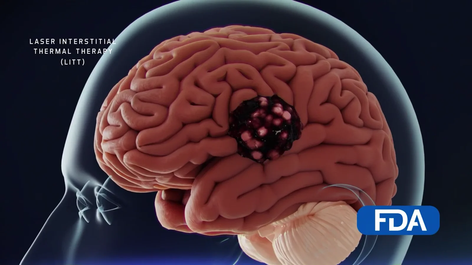 Brain Tumor Center molecular animation frame